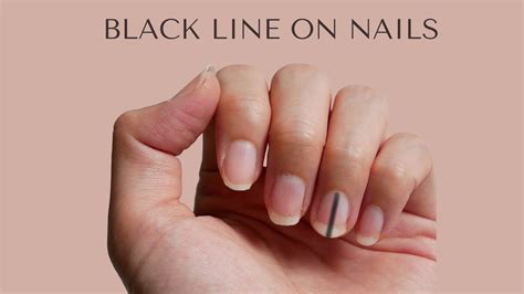 black lining on nails